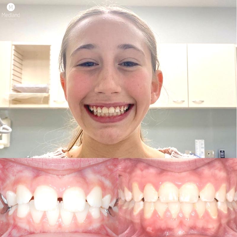 What If I Don't Wear a Retainer After Braces Come Off? - Medland