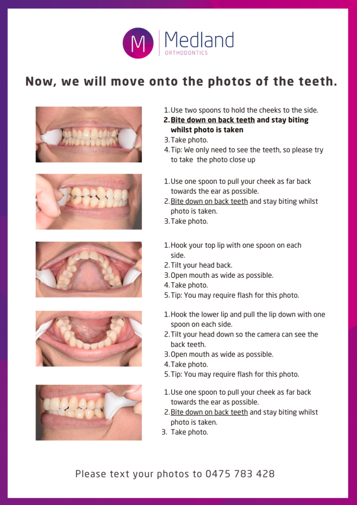 Lingual Braces: Top 5 Facts